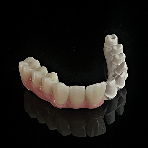 Pekkton Thimble Bar Hybrid with all Ceramic Crowns - GPS Dental